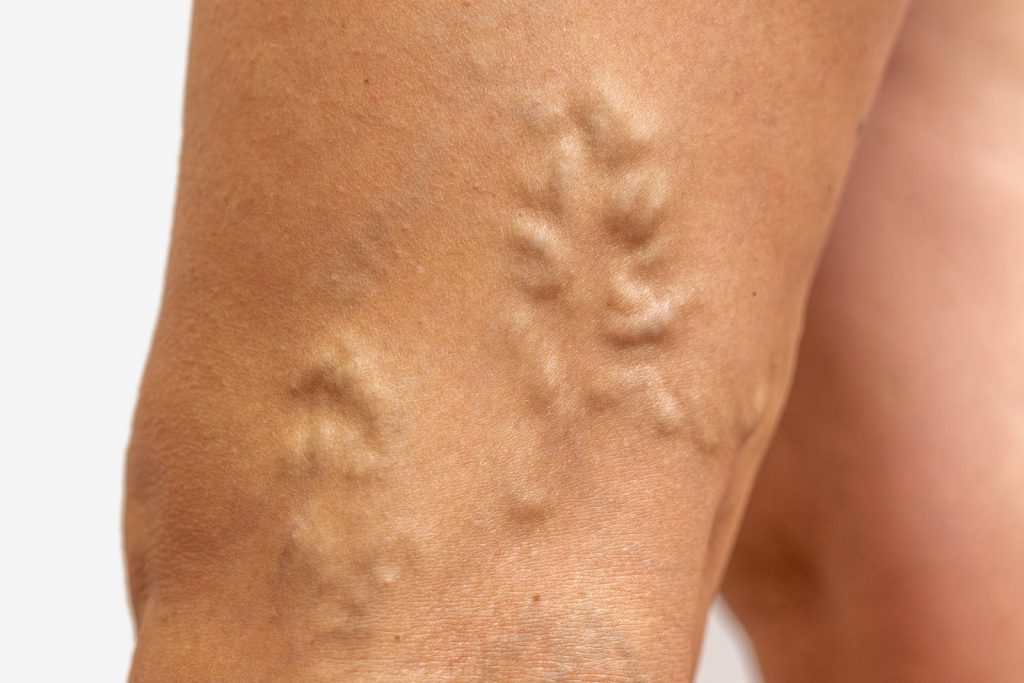 varicose veins on the skin. Macro shot. Madical and cosmetic problem. Close up