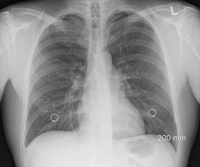 senior24h-płuca-choroba-nadcisnienie płuc